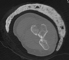 Capitellar Fracture CT Axial